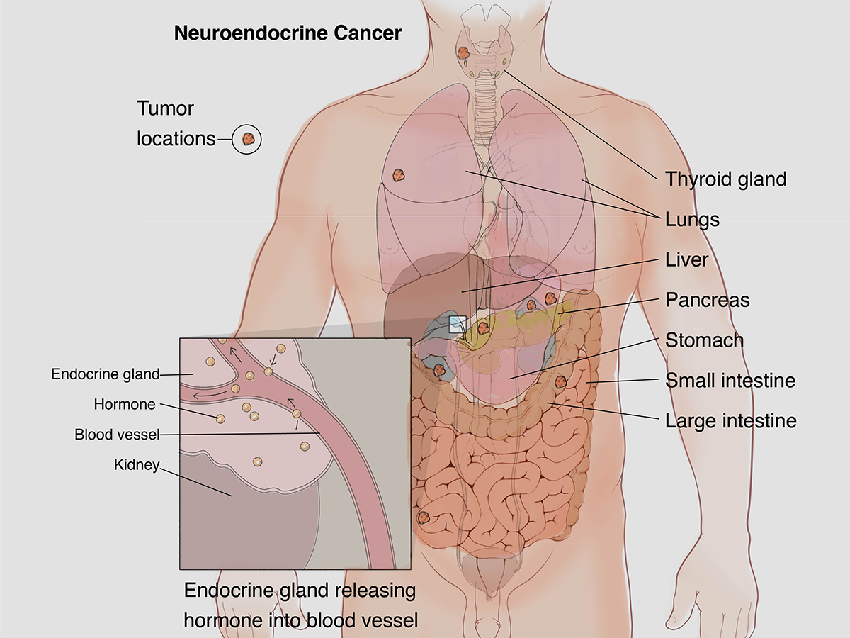 neuroendocrine-cancer